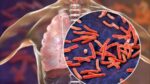 Hoje assinala-se Dia Mundial de Combate à Tuberculose: OMS recomenda novas ferramentas de diagnóstico para erradicar a doença